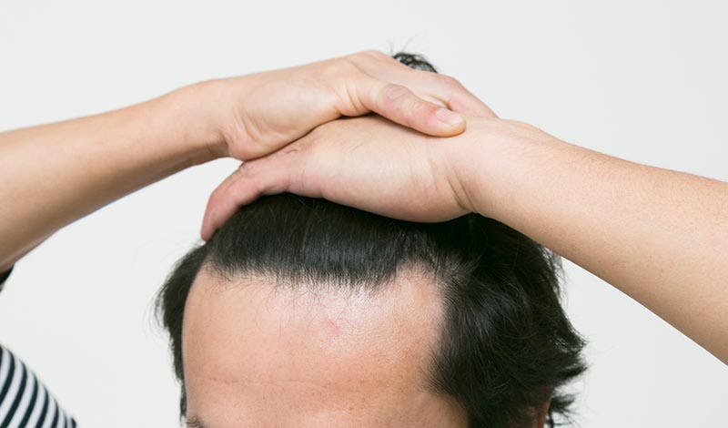 生え際が薄いと感じたら すぐにやるべき対策一覧 髪コト 頭髪を通じてライフスタイルを豊かにするための情報を発信 生え際が薄いと感じたら すぐにやるべき対策一覧 髪コト 頭髪を通じてライフスタイルを豊かにするための情報を発信