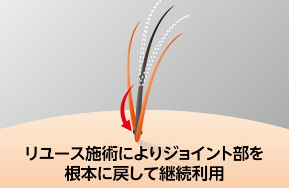 【たった1分】あなたに合った薄毛対策が分かる！～スヴェンソン無双～