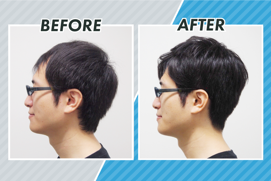 スヴェンソン式増髪法「編み込み式増髪」によるビフォーアフター写真1（側頭部）