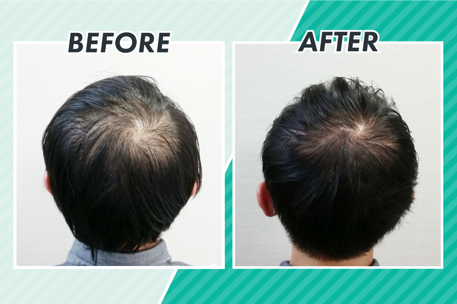 たった1分】あなたに合った薄毛対策が分かる！～スヴェンソン無双