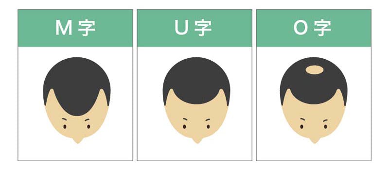 薄毛の3タイプ、M・U・Oのイメージ画像