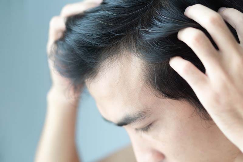 おでこの生え際の薄毛に悩む男性のイメージ画像