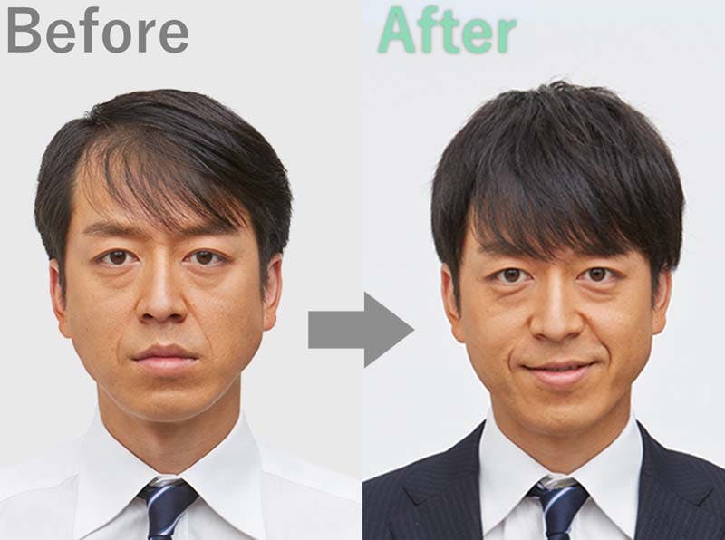 おでこの生え際の薄毛は増毛で解決 前髪が薄くなる原因は 髪コト 頭髪を通じてライフスタイルを豊かにするための情報を発信 おでこの生え際の薄毛は増毛で解決 前髪が薄くなる原因は 髪コト 頭髪を通じてライフスタイルを豊かにするための情報を発信