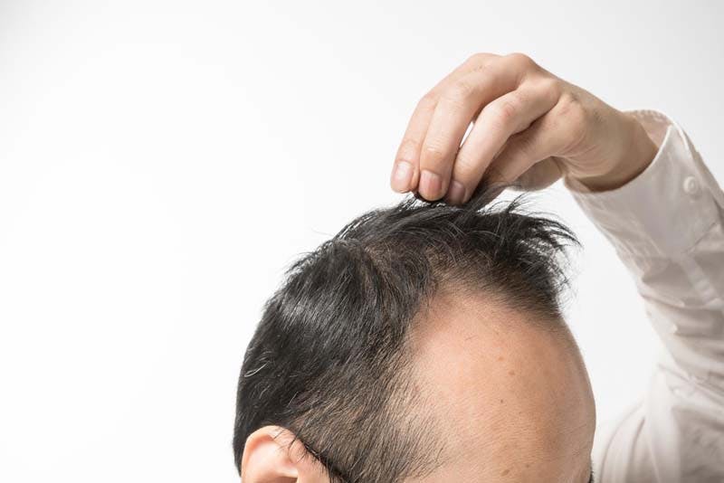 これから増毛を行う男性の画像