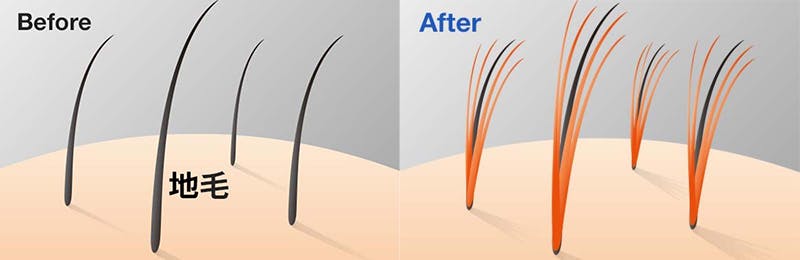結毛式増毛前の頭髪イメージ 結毛式増毛後の頭髪イメージ
