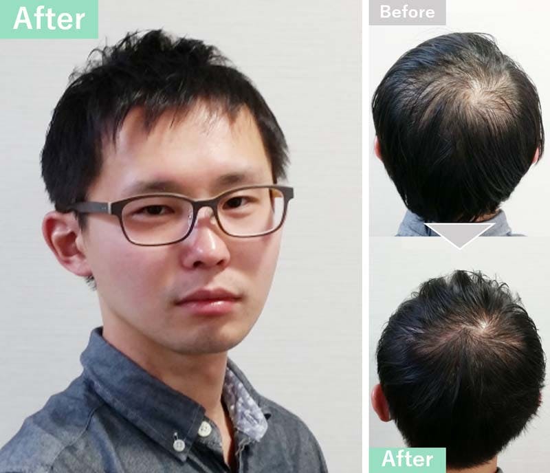 つむじ割れでお悩みの男性必見 6つの原因と対策 髪コト 頭髪を通じてライフスタイルを豊かにするための情報を発信 つむじ割れでお悩みの男性必見 6つの原因と対策 髪コト 頭髪を通じてライフスタイルを豊かにするための情報を発信