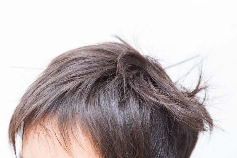 つむじ割れでお悩みの男性必見 6つの原因と対策 髪コト 頭髪を通じてライフスタイルを豊かにするための情報を発信