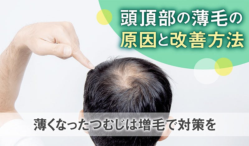 頭頂部の薄毛の原因と改善方法｜薄くなったつむじは増毛で対策