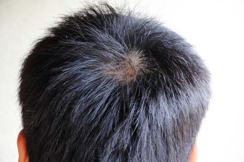 頭頂部が薄毛になる原因と改善方法 薄くなったつむじは増毛で対策を 髪コト 頭髪を通じてライフスタイルを豊かにするための情報を発信