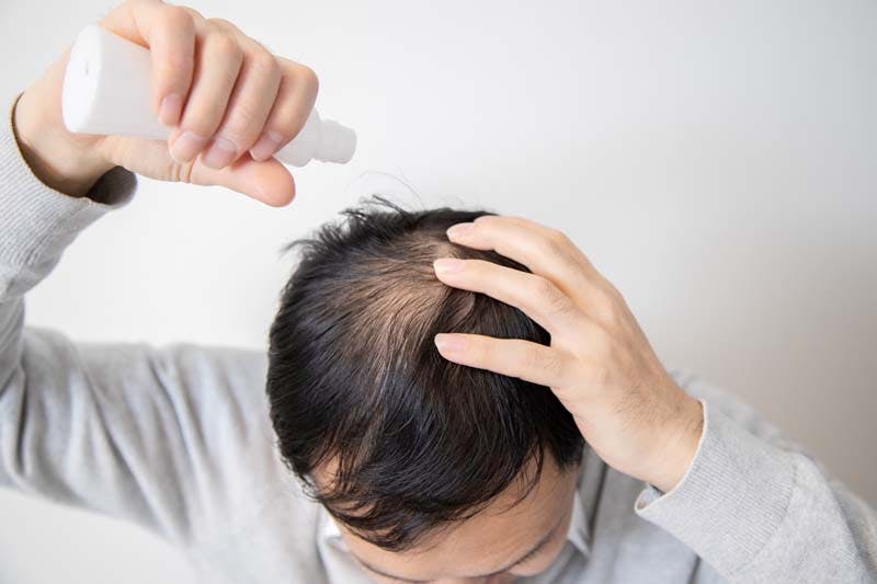 頭頂部のハゲを改善しようとする男性の画像