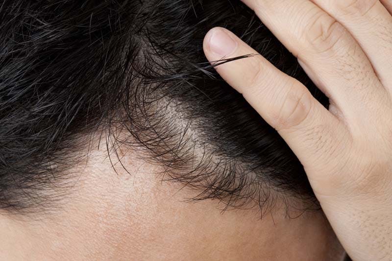 頭皮が乾燥すると薄毛になる 頭皮環境の悪化を招く原因と乾燥予防 髪コト 頭髪を通じてライフスタイルを豊かにするための情報を発信