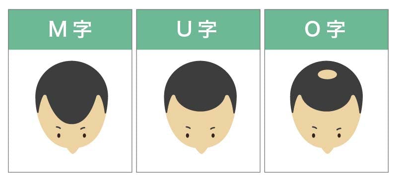 薄毛の3タイプのイメージイラスト(M字・U字・O字)