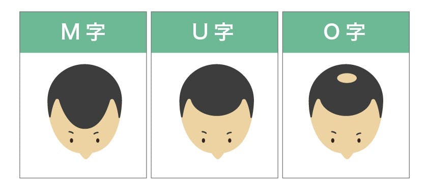 薄毛の種類(M字U字O字)のイメージイラスト
