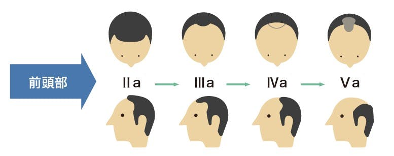 ハミルトンノーウッド分類「前頭部」　進行イメージイラスト