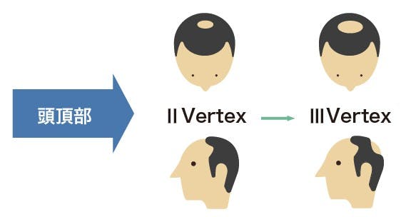 ハミルトンノーウッド分類「頭頂部」　進行イメージイラスト