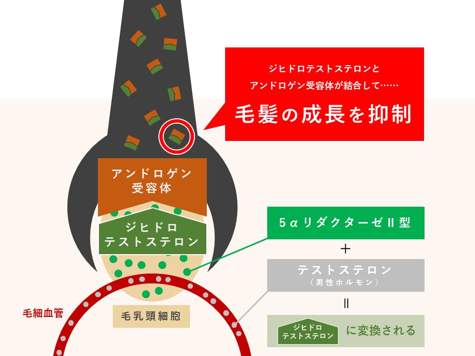 テストステロンと5αリダクターゼⅡ型が髪の毛の成長を抑制する仕組みのイメージ図