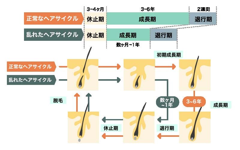 正常なヘアサイクルと乱れたヘアサイクルを比べたイラスト