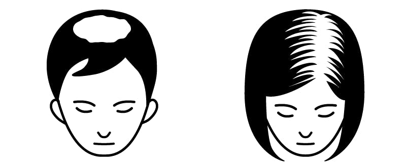 AGA(男性型脱毛症)とFAGA(女性男性型脱毛症)のイラスト画像