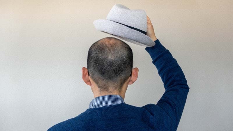 帽子を取る薄毛(はげ)の男性のイメージ画像