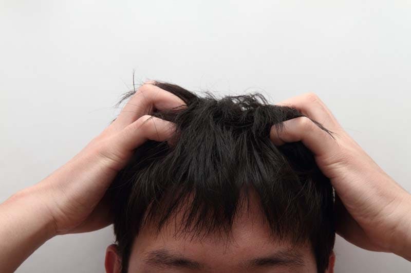 頭皮にかさぶたができる原因は はげと関係ある 治し方や予防対策 髪コト 頭髪を通じてライフスタイルを豊かにするための情報を発信