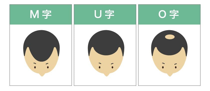 M字ハゲ・U字ハゲ・O字ハゲのイメージイラスト