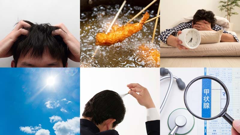 男性の後頭部における主な原因のイメージ画像(精神的なストレス・脂っこい食事・生活習慣の乱れ・頭皮へのダメージ・強い摩擦やひっぱり・免疫や甲状腺の病気)