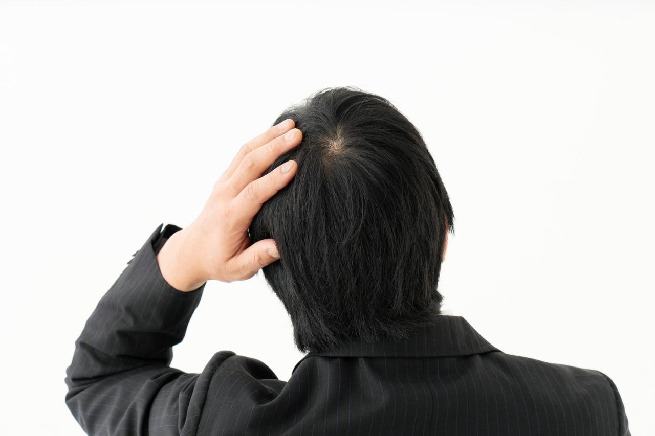 後頭部（つむじ）の薄毛を気にする男性