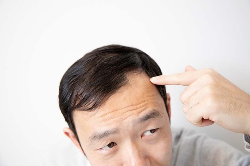 前髪が薄い はげてきた 原因と改善対策 M字はげの男性必見 髪コト 頭髪を通じてライフスタイルを豊かにするための情報を発信