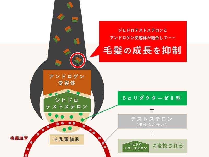 テストステロンと5αリダクターゼⅡ型が髪の毛の成長を抑制する仕組みのイメージ図