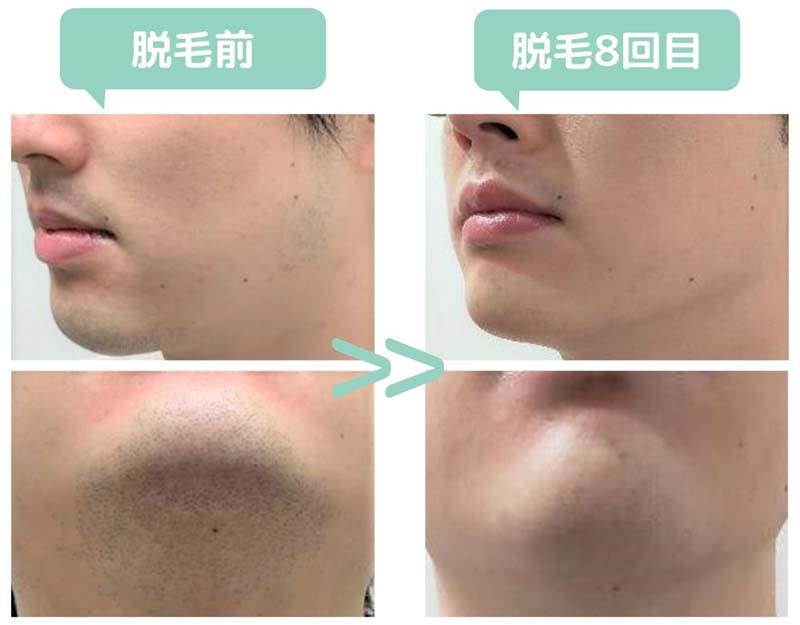 MEN'S WILL池袋店で髭脱毛を受けたSさんのビフォーアフター画像