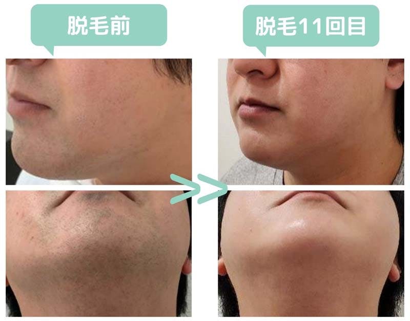 MEN'S WILL池袋店で髭脱毛を受けたKさんのビフォーアフター画像