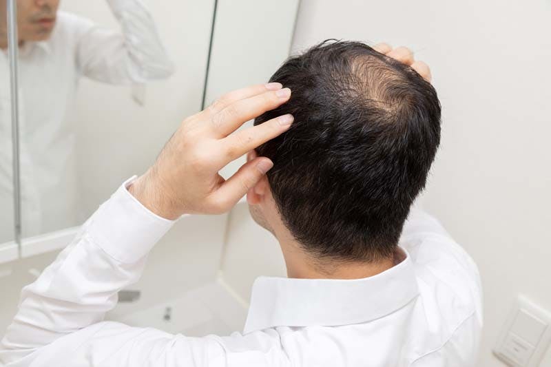 薄毛に悩む男性の画像