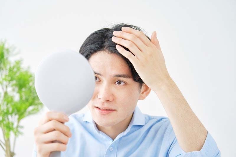 薄毛に悩む20代男性の画像
