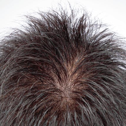 Hairline Premier
