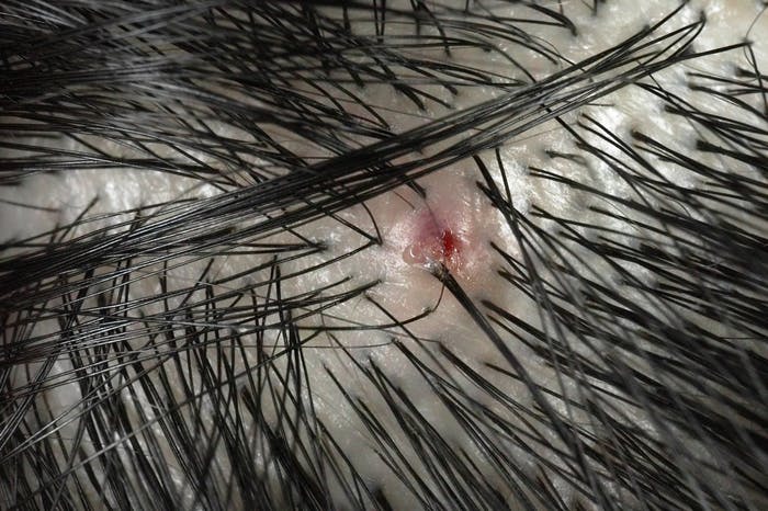 皮膚にできた赤ニキビの拡大画像