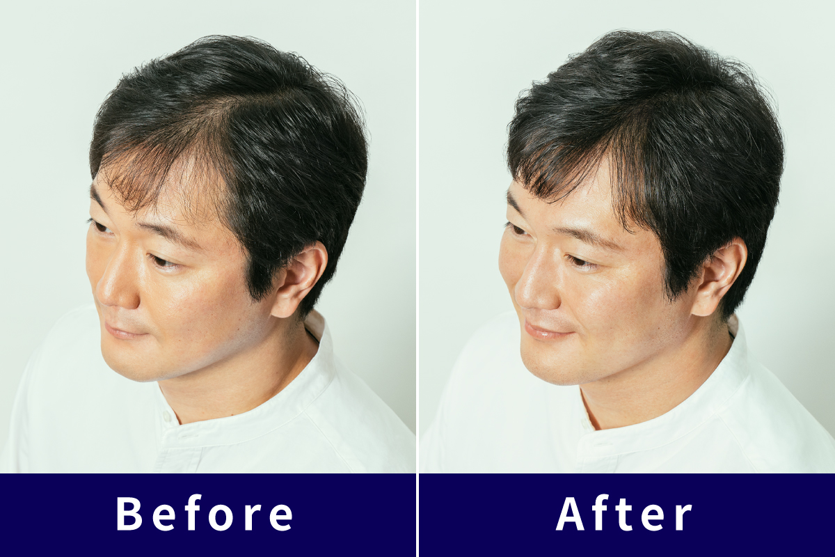 Extension Before After 1