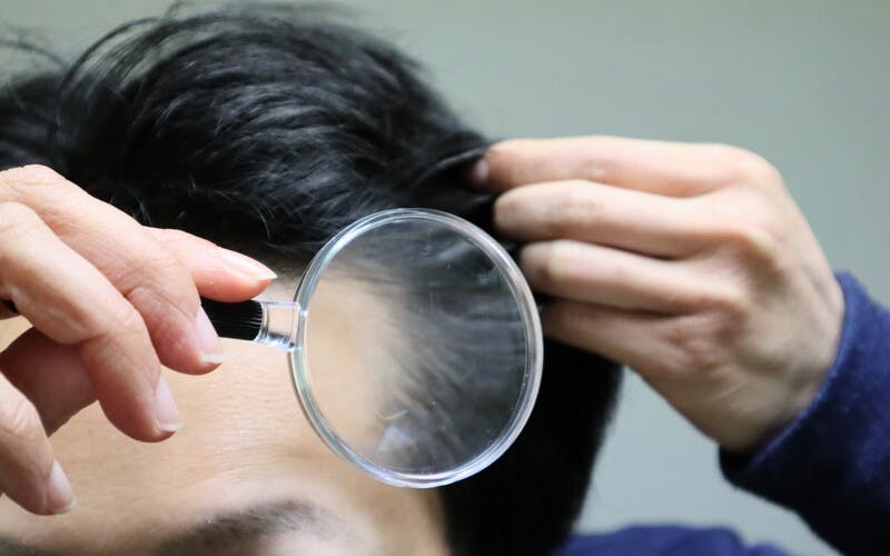 こめかみ上部の髪の状態をルーペで確認する中年男性