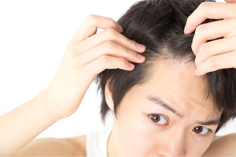 髪をかき分けて生え際の状態をチェックする男性