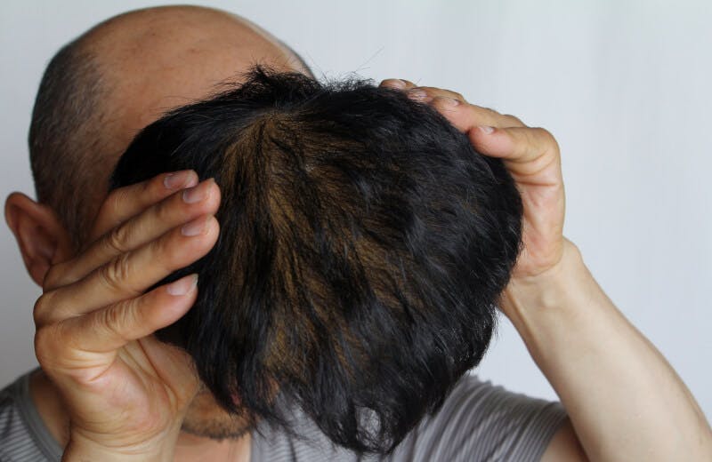 かつらを着用しようとする薄毛の男性