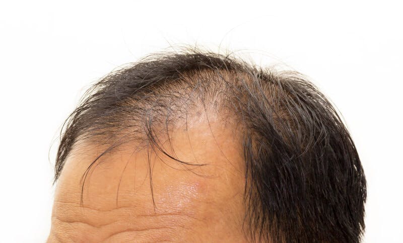 薄毛が進行している頭頂部と生え際の様子