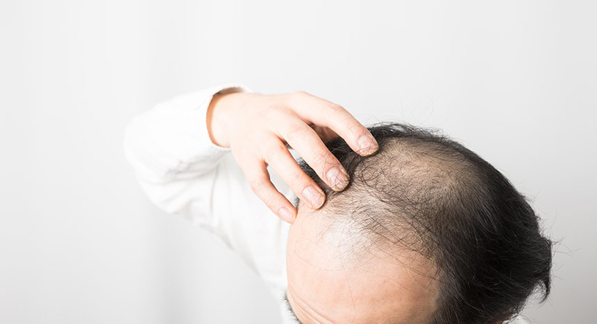 前髪から頭頂部にかけて地毛がほとんどないのですが マイヘアプラスはできますか 男性用ファッションウィッグ かつら 増毛や薄毛対策のメンズスヴェンソン